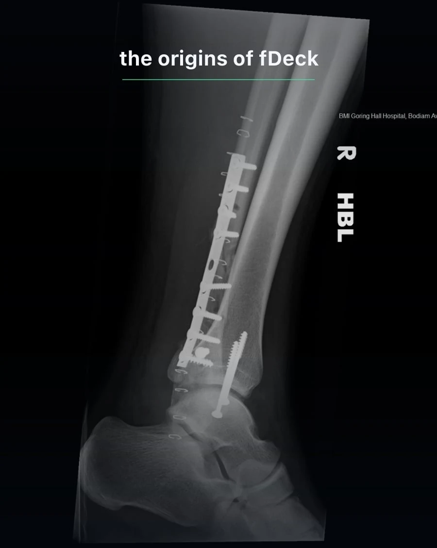 X-ray of a repaired ankle — the origins of fDeck